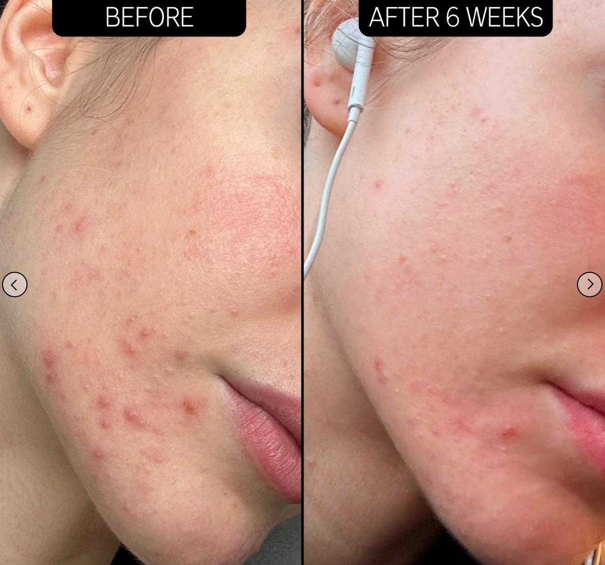 THE INKEY LIST Crème de nuit anti-acné Blemish Clearing 2% Novoretin