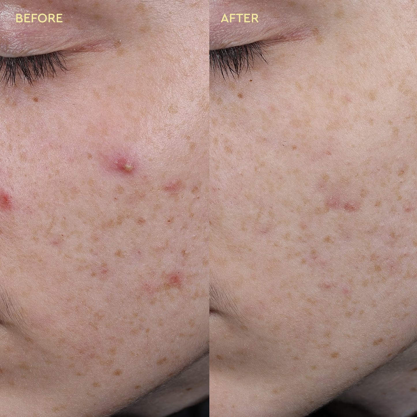 BYOMA Pâte de soin anti-boutons