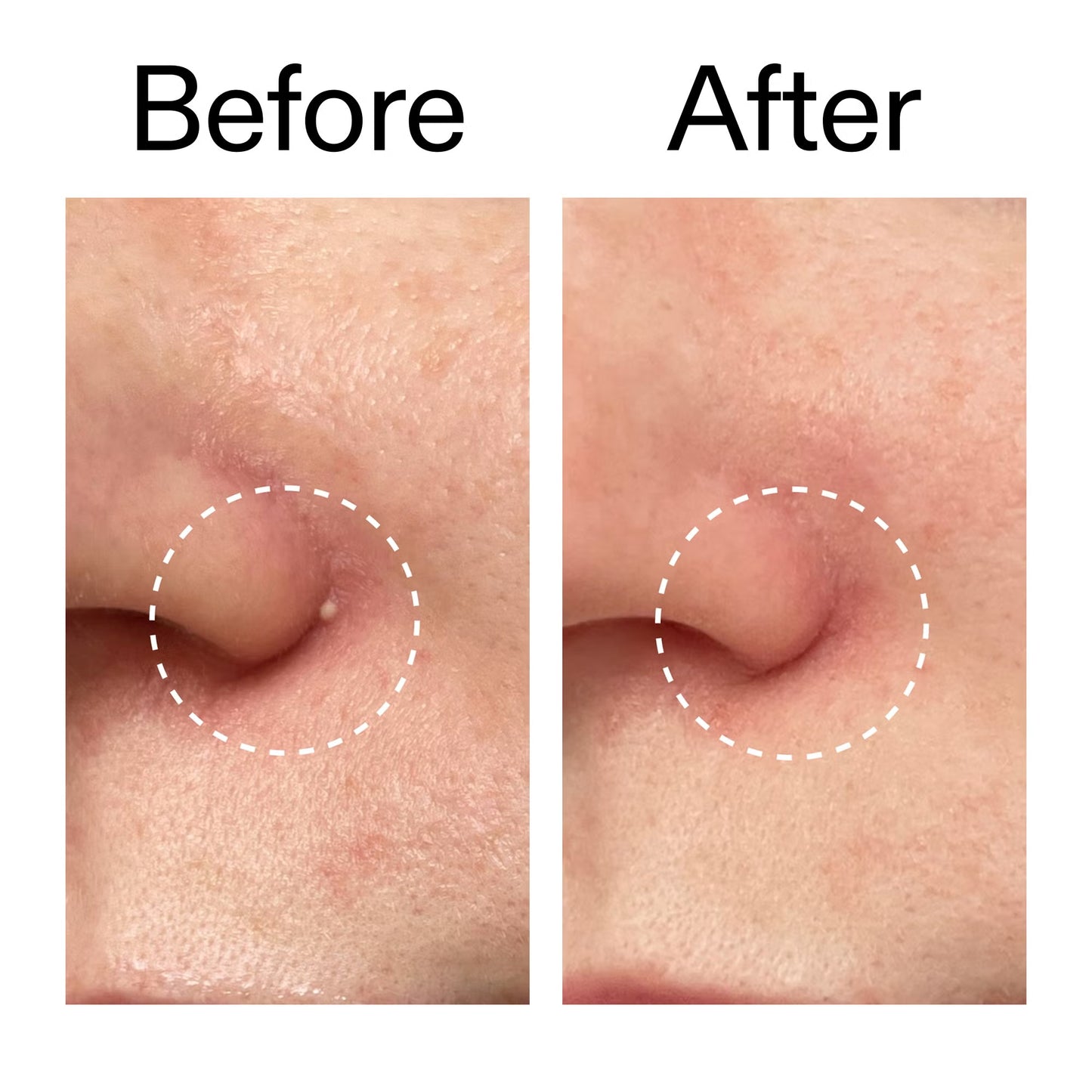 THE INKEY LIST Patchs invisibles Hydrocolloid anti-acné