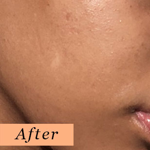 PANOXYL Nettoyant moussant anti-acné au Peroxyde de benzoyle 10%